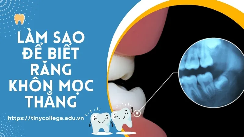 Làm sao để biết răng khôn mọc thẳng? Những điều cần chú ý 1