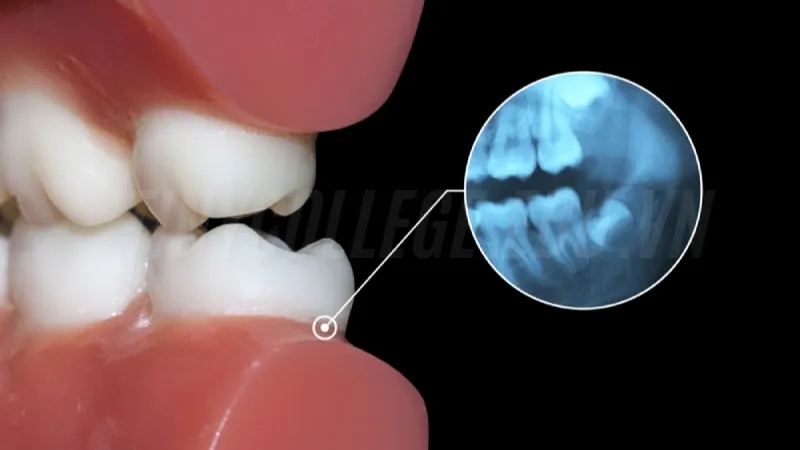 Làm sao để biết răng khôn mọc thẳng? Những điều cần chú ý 3