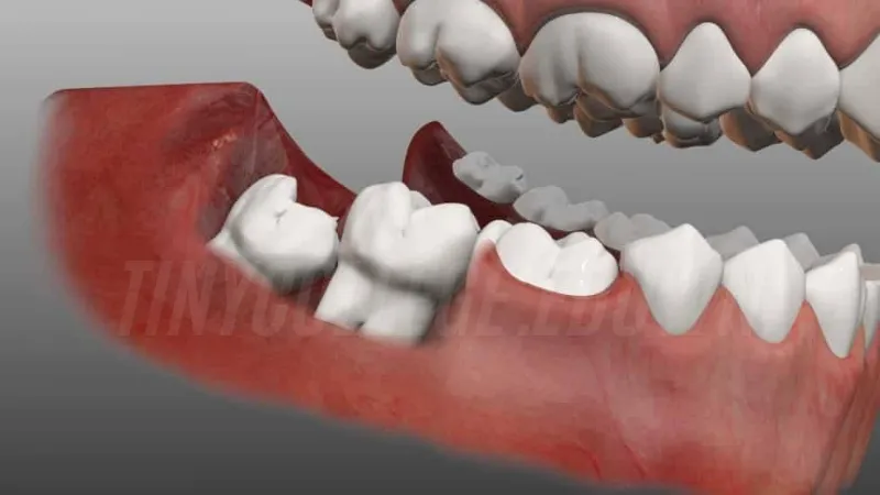 Làm sao để biết răng khôn mọc thẳng? Những điều cần chú ý 5