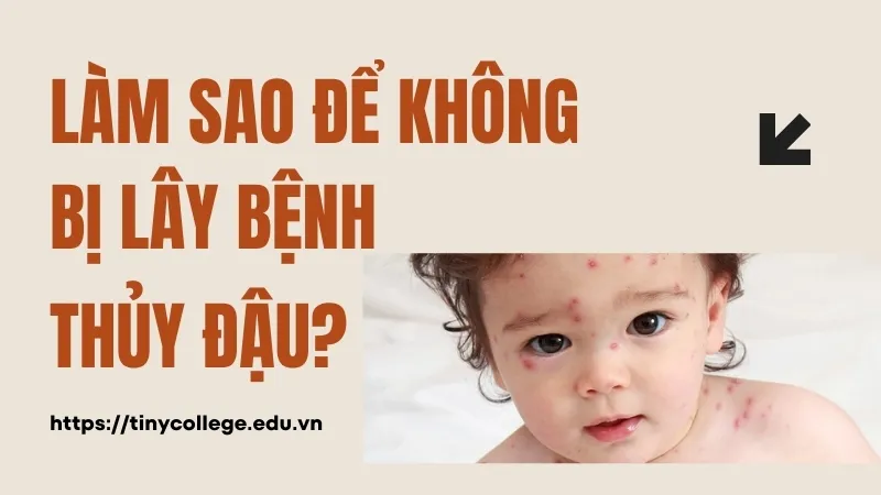 Làm sao để không bị lây thủy đậu? Những điều cần biết 1