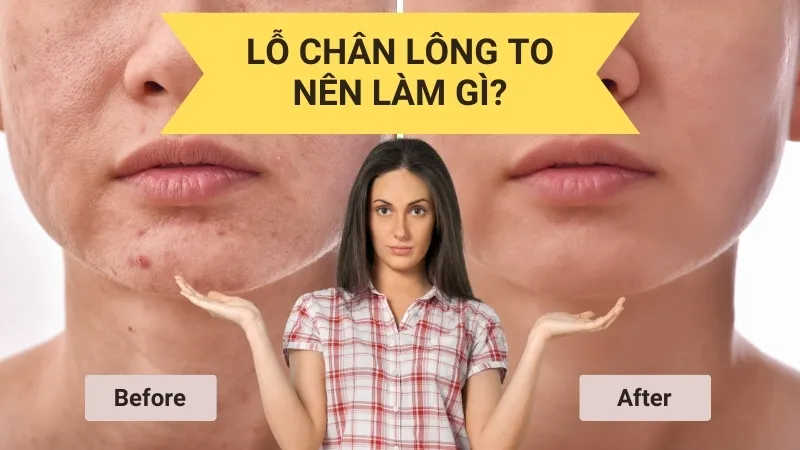 Lỗ chân lông to nên làm gì? Top 6 cách trị hiệu quả 1