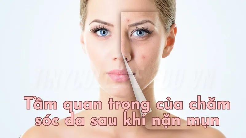 Sau khi lấy nhân mụn nên làm gì? Biện pháp chăm sóc da hiệu quả 2