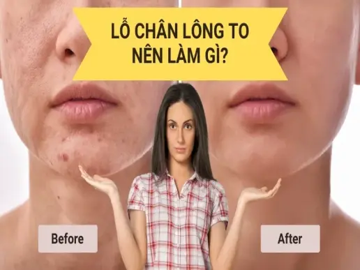 Lỗ chân lông to nên làm gì? Top 6 cách trị hiệu quả