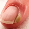 Bí quyết chữa chín mé hiệu quả tại nhà và khi nào cần gặp bác sĩ