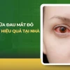 Mẹo Chữa Đau Mắt Đỏ Nhanh Nhất: Hướng Dẫn Chi Tiết Tại Nhà
