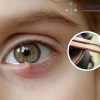 Mẹo chữa lẹo mắt dân gian: Giải pháp an toàn và hiệu quả tại nhà