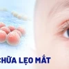 Mẹo Trị Lẹo Mắt Nhanh Nhất Tại Nhà Hiệu Quả Trong Một Nốt Nhạc