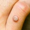Mẹo Trị Mụn Cóc Bằng Dân Gian: Hiệu Quả, An Toàn và Dễ Thực Hiện