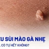 Tư vấn sùi mào gà: Nguyên nhân, triệu chứng và cách điều trị hiệu quả