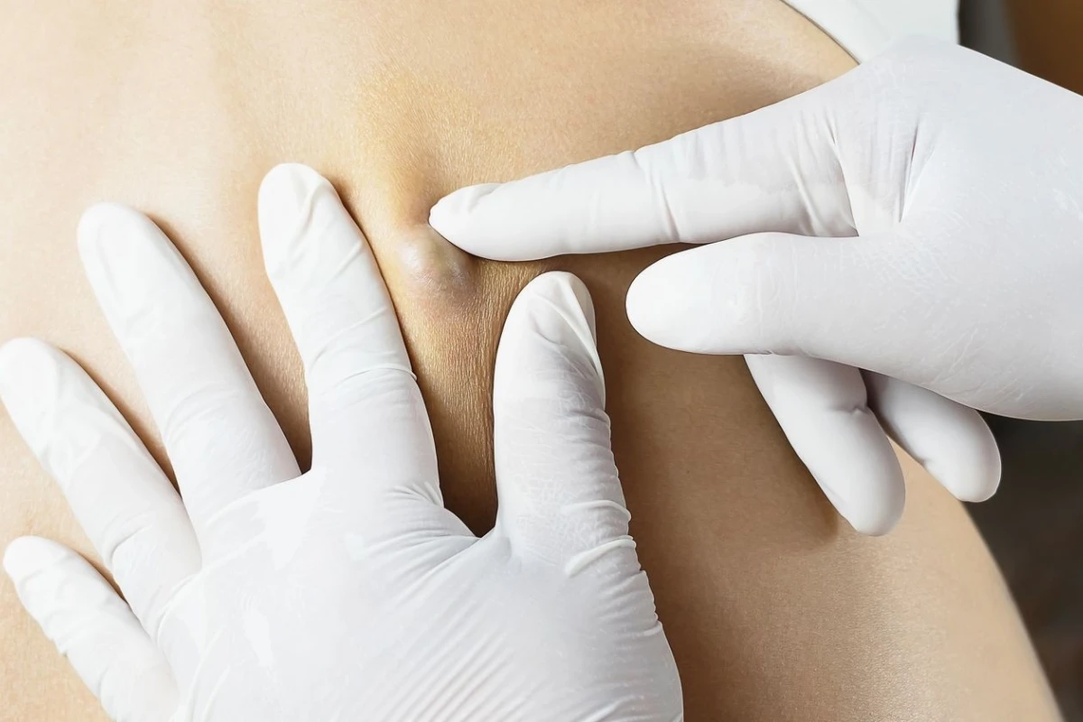 Mẹo dân gian chữa u bã đậu: An toàn hay tiềm ẩn rủi ro?