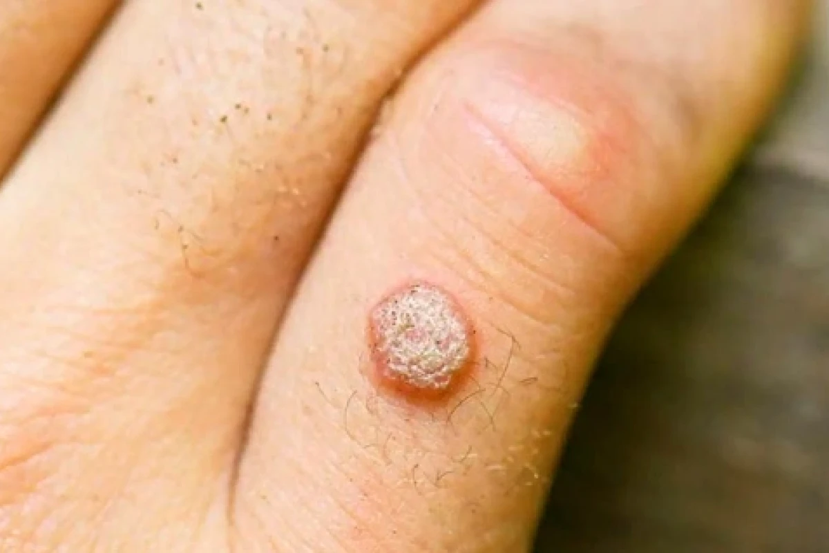 Mẹo Trị Mụn Cóc Bằng Dân Gian: Hiệu Quả, An Toàn và Dễ Thực Hiện