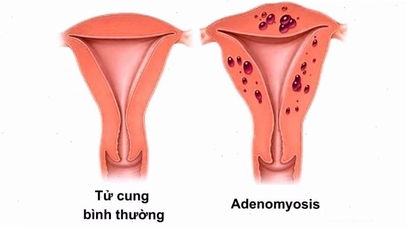 Adenomyosis có thể gây ra tình trạng đau bụng kinh dữ dội