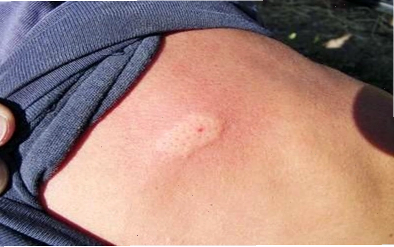 Áp dụng các biện pháp sơ cứu và mẹo dân gian khi bị bọ cạp cắn
