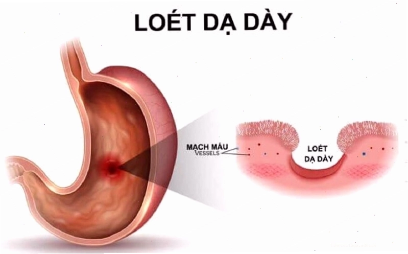 Bệnh viêm loét dạ dày có thể gây nên triệu chứng xót ruột kéo dài