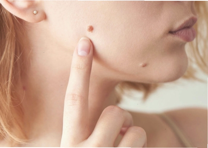 Các nguyên liệu tự nhiên dùng để trị mụn cóc tại nhà