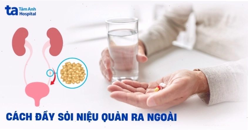 Cách đẩy sỏi niệu quản ra ngoài