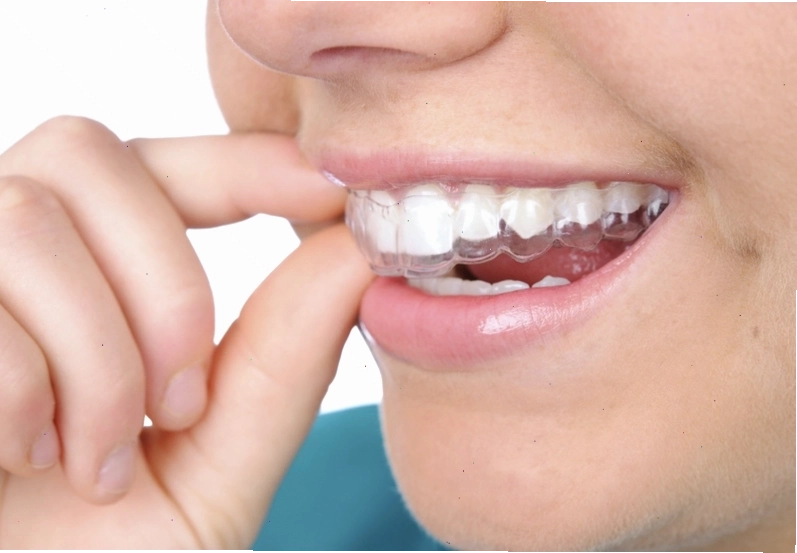 Cách làm trắng răng sau 1 đêm với máng tẩy trắng răng