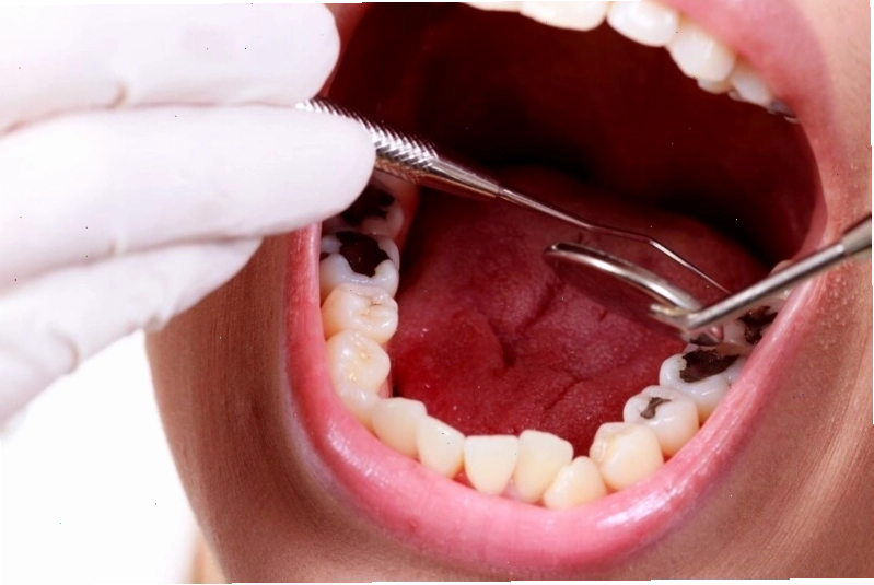 Cần đi khám nha sĩ để tìm nguyên nhân và điều trị nhức răng dứt điểm