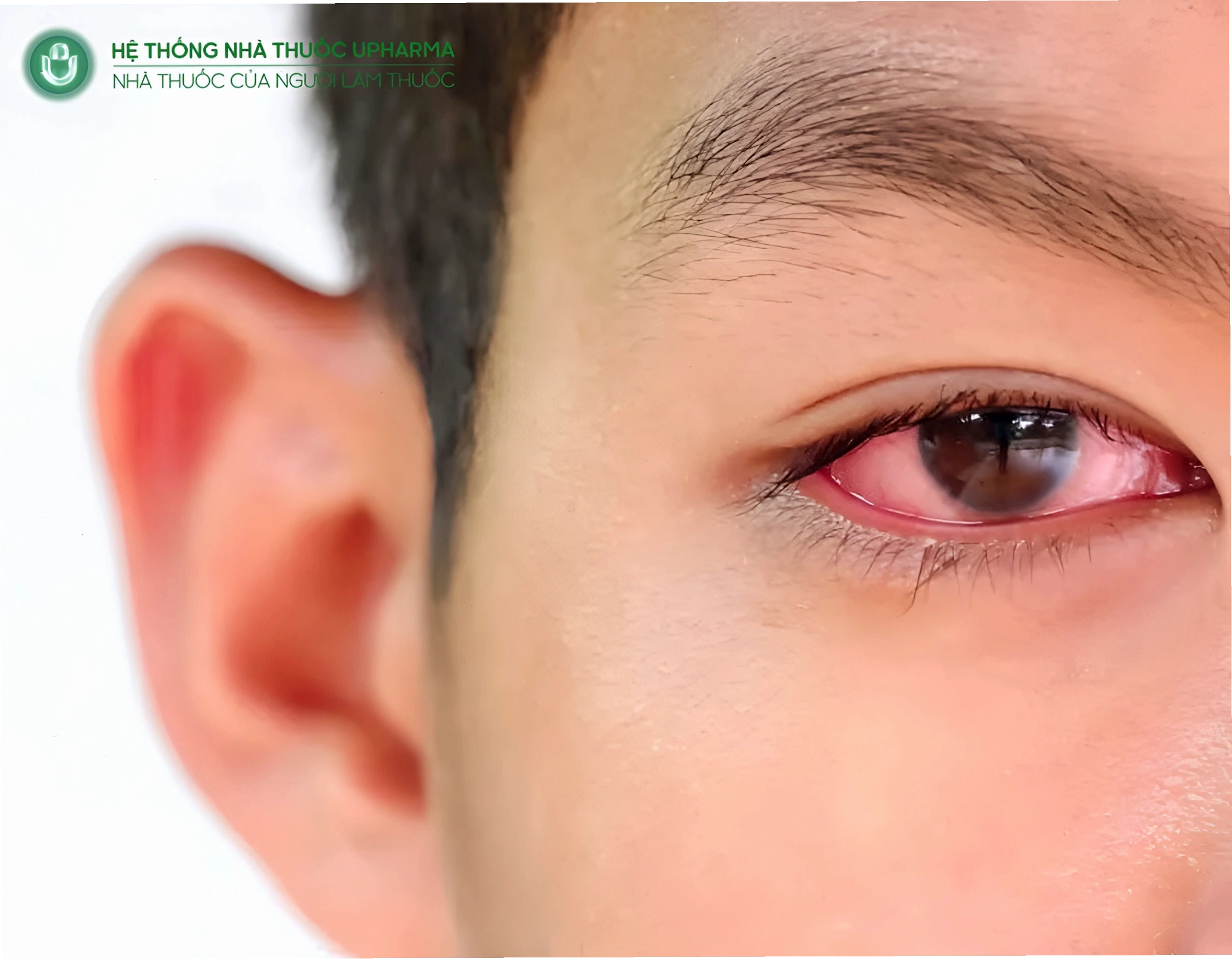 Chườm mát giúp giảm sưng đỏ mắt