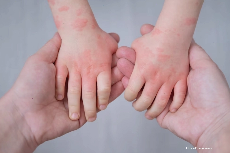Có nhiều nguyên nhân gây nên tình trạng nổi mề đay ở trẻ