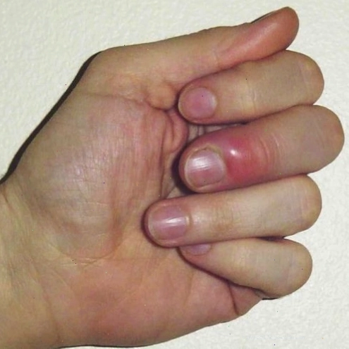 Đầu ngón tay sưng, nhức có mủ là dấu hiệu bệnh gì?