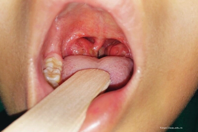 Hình ảnh minh họa viêm amidan: Bệnh thường gặp ở mọi lứa tuổi