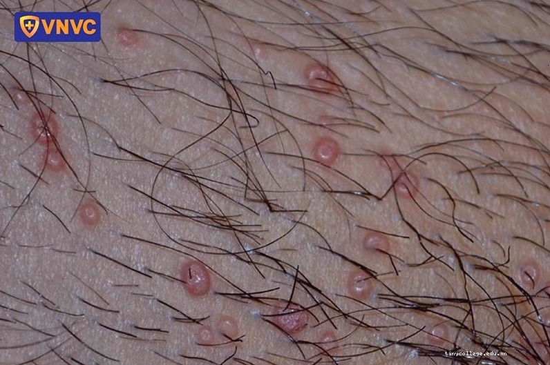 Hình ảnh sùi mào gà nhẹ ở nam giới
