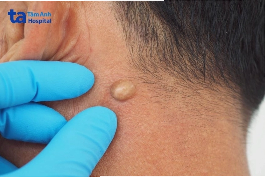 Không nên tự ý điều trị u bã đậu tại nhà