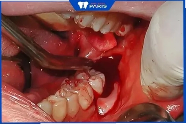 Nhổ răng bị chảy máu trong giấc mơ