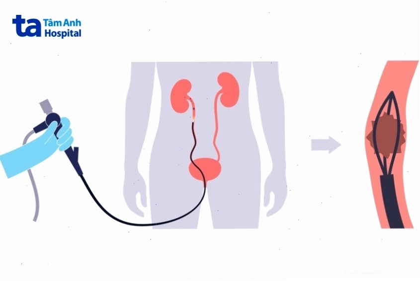 Nội soi tán sỏi bằng ống mềm trong điều trị sỏi niệu quản