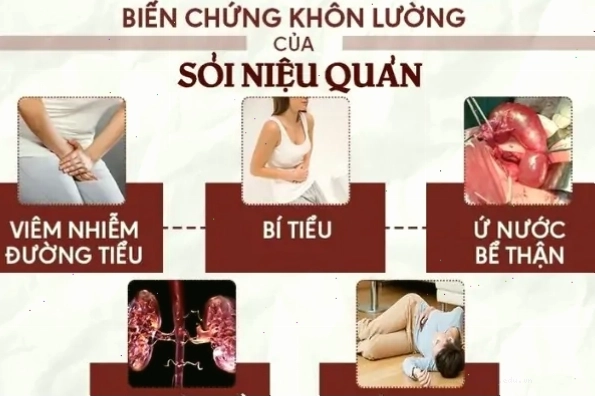 Sỏi niệu quản thường gây ra những biến chứng không ngờ ảnh hưởng sức khỏe người bệnh