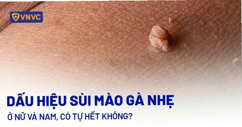Sùi mào gà thể nhẹ