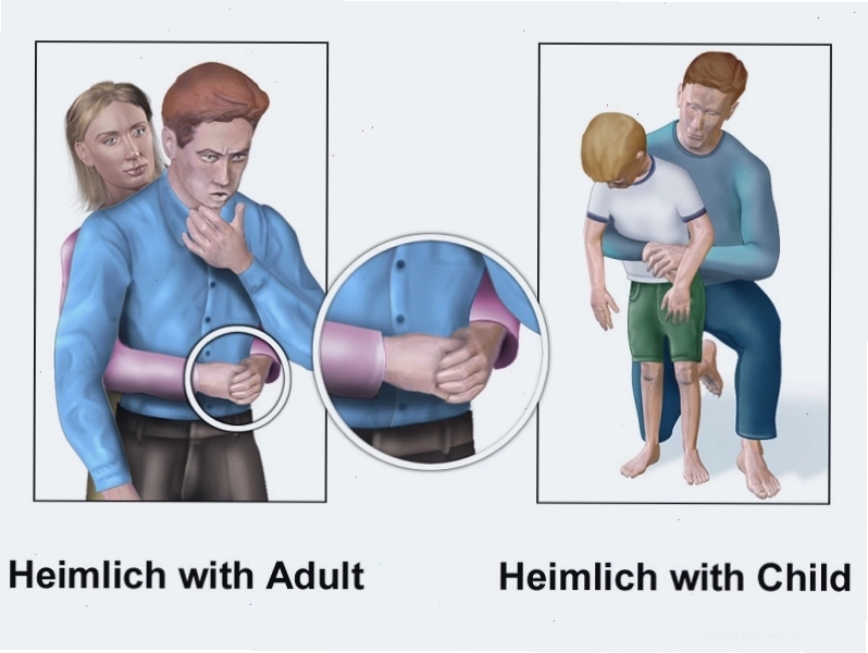 Thao tác ép bụng, vỗ lưng giúp đẩy xương cá ra ngoài