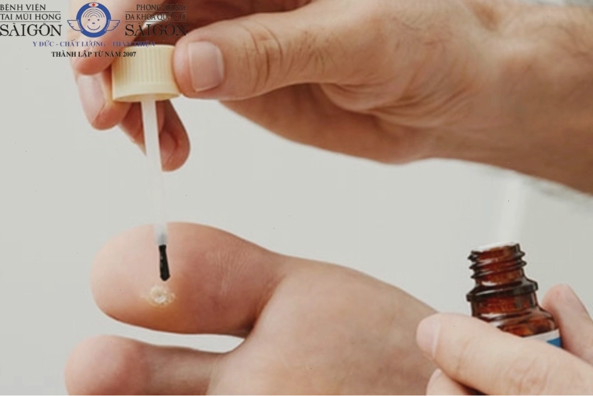Tìm đến bác sĩ để được chỉ định phương pháp trị mụn cóc phù hợp