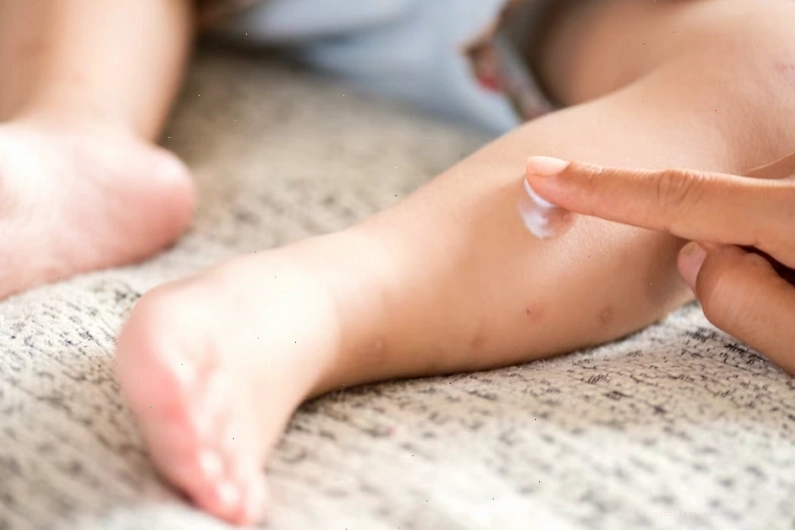 Trẻ nên được dùng kem dưỡng ẩm đúng cách khi bị nổi mề đay