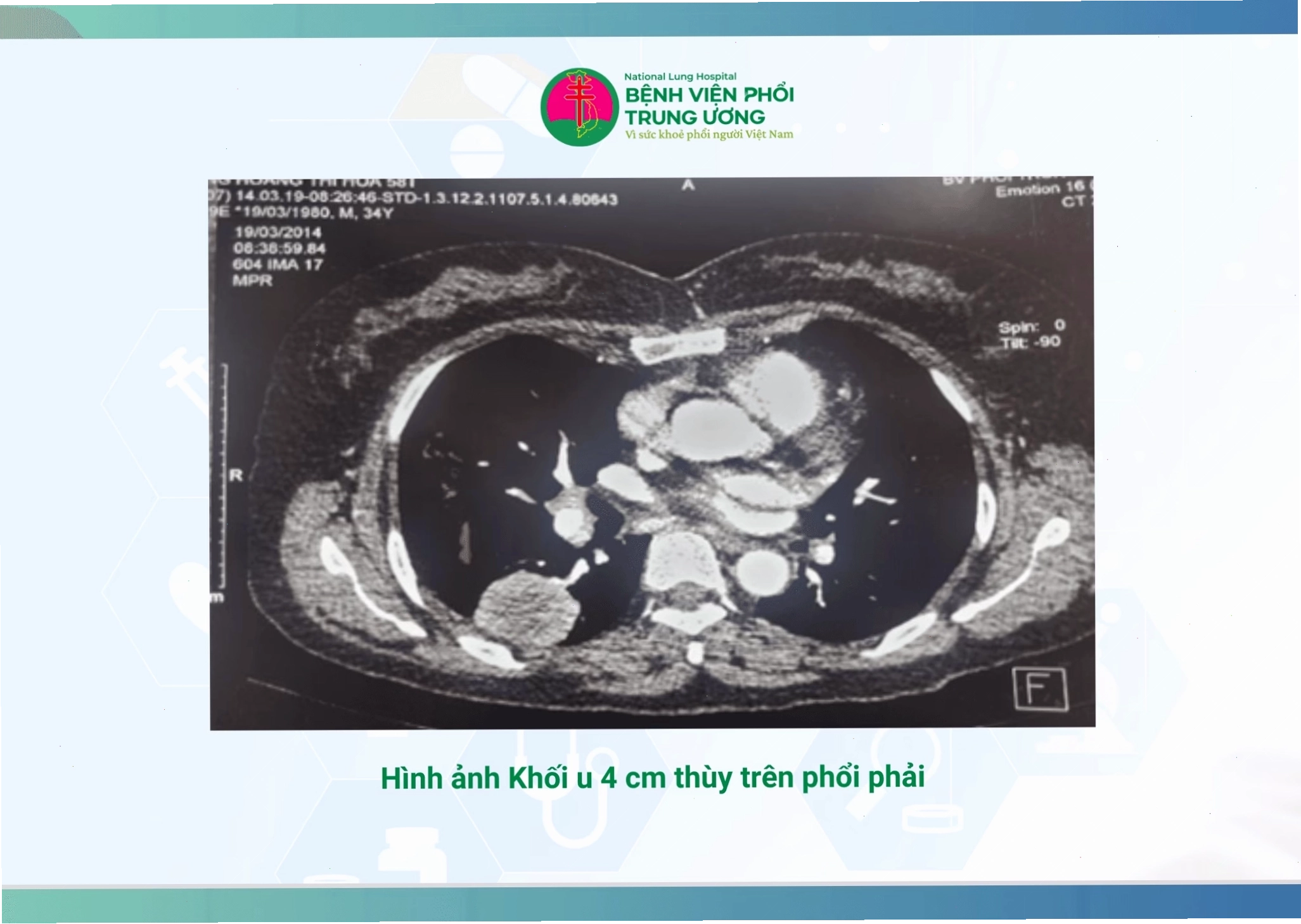 Tư vấn điều trị ung thư phổi không tế bào nhỏ bằng thuốc thế hệ 1