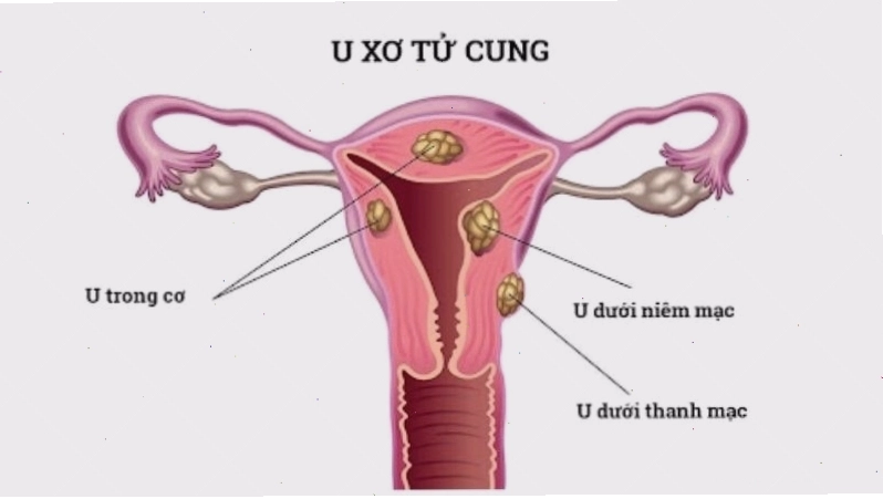 U xơ tử cung là một dạng u lành tính của tử cung