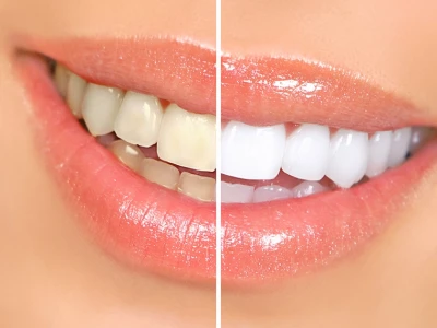 Bật mí mẹo làm trắng răng tại nhà hiệu quả, an toàn và tiết kiệm