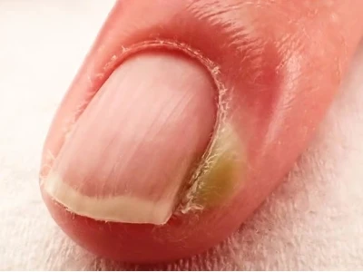Bí quyết chữa chín mé hiệu quả tại nhà và khi nào cần gặp bác sĩ