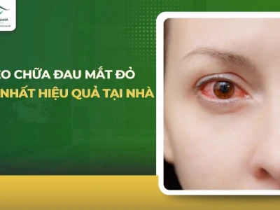 Mẹo Chữa Đau Mắt Đỏ Nhanh Nhất: Hướng Dẫn Chi Tiết Tại Nhà