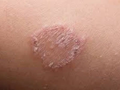 Mẹo chữa hắc lào tại nhà hiệu quả và nhanh chóng