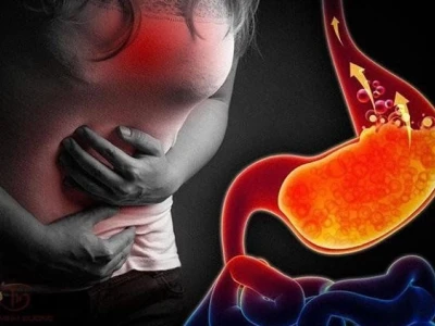Mẹo Chữa Trào Ngược Dạ Dày Thực Quản Hiệu Quả Tại Nhà