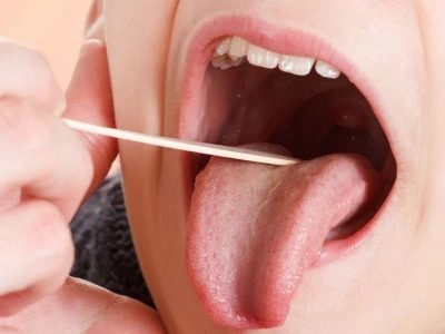 Mẹo Chữa Viêm Amidan Hốc Mủ Tại Nhà Hiệu Quả Không Cần Thuốc