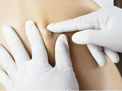 Mẹo dân gian chữa u bã đậu: An toàn hay tiềm ẩn rủi ro?