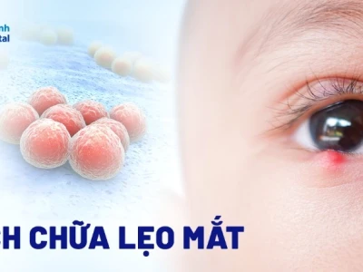 Mẹo Trị Lẹo Mắt Nhanh Nhất Tại Nhà Hiệu Quả Trong Một Nốt Nhạc