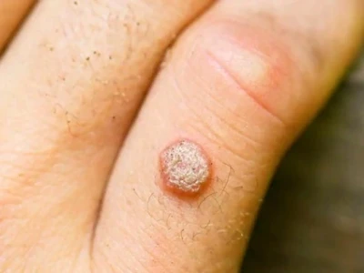 Mẹo Trị Mụn Cóc Bằng Dân Gian: Hiệu Quả, An Toàn và Dễ Thực Hiện