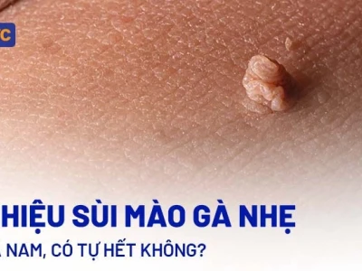 Tư vấn sùi mào gà: Nguyên nhân, triệu chứng và cách điều trị hiệu quả